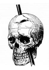 Phineas gage skull injury