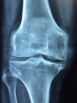 Kneecap x ray