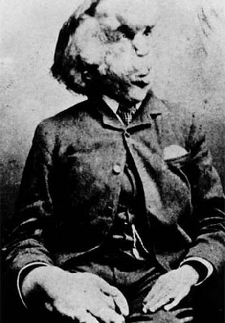 Joseph Merrick the Elephant Man