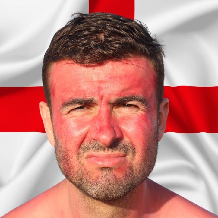 A sunburned man grimacing in front of an England flag